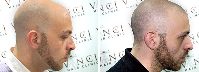 Medical Clinic Create Hair Tattoos For Bald Men - Life Guide
